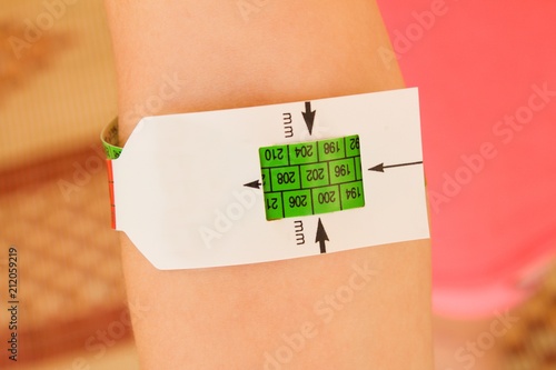 Measuring malnutrition using strap MUAC mid-upper-arm-circumference.The hand of a healthy well-fed child.