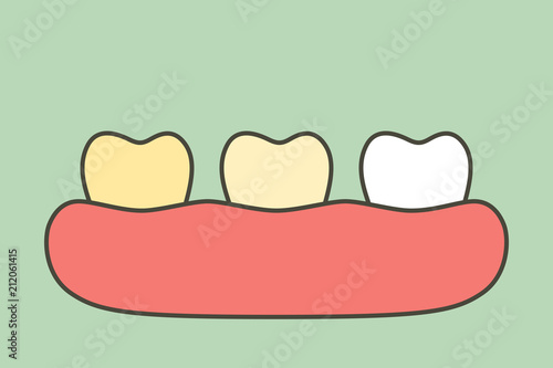 yellow to white tooth, teeth whitening before and after - dental cartoon vector flat style
