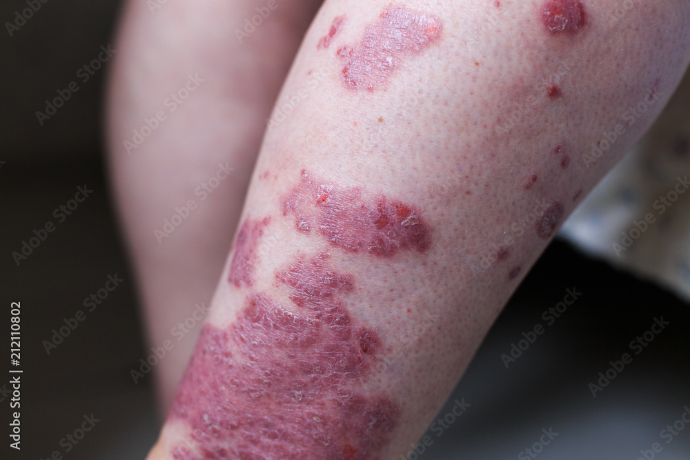 Fototapeta premium Psoriasis vulgaris is an autoimmune disease that affects the skin, detail photography for mainly medical magazines. Atopic dermatitis or eczema, is a type of inflammation of the skin at foot.