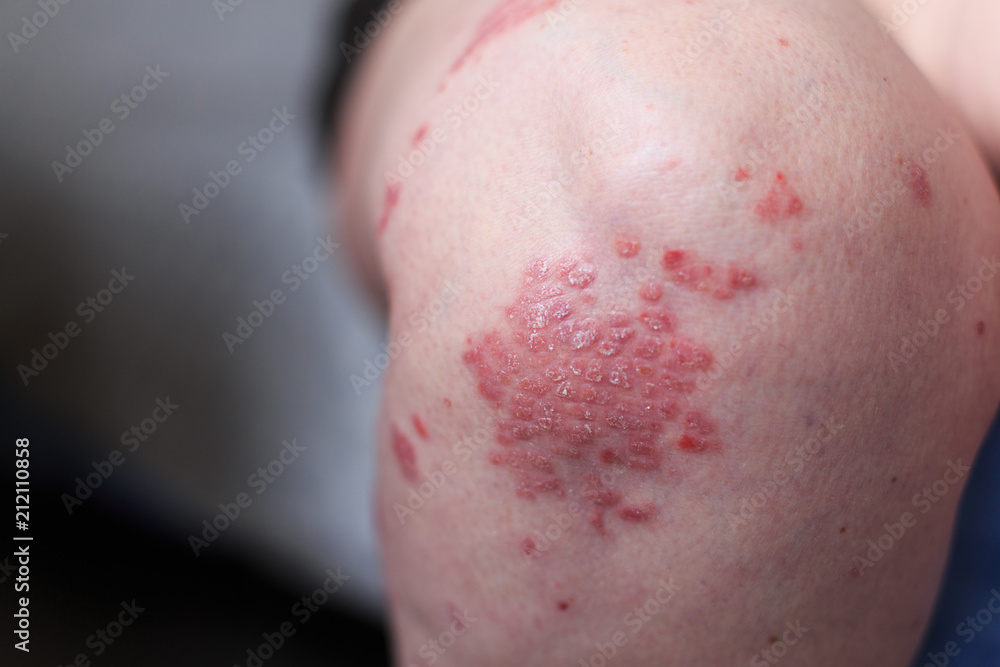 Psoriasis vulgaris is an autoimmune disease that affects the skin, detail photography for mainly medical magazines. Atopic dermatitis or eczema, is a type of inflammation of the skin at foot. Psoriasis vulgaris is an autoimmune disease that affects the skin, detail photography for mainly medical magazines. Atopic dermatitis or eczema, is a type of inflammation of the skin at foot.