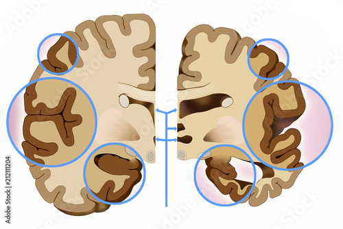Fotografie This illustration shows in two halves of the brain, the difference of brain mass in Alzheimer's disease, this causes damage to the brain that prevents thinking, planning and remembering