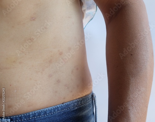 Atopic dermatitis on skin body on white background