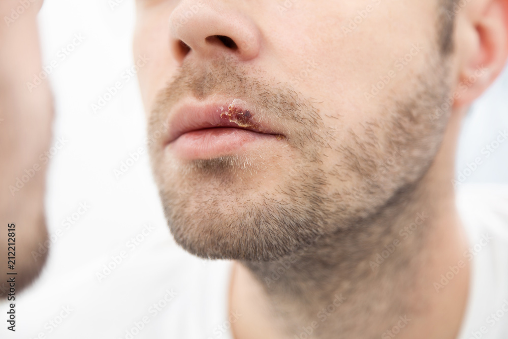 Young man suffering from herpes on his mouth Young man suffering from herpes on his mouth