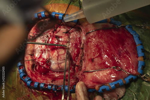 Bild auf Leinwand Doctor performing brain surgery in operating room
