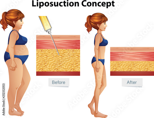 Human Liposuction Concept diagram