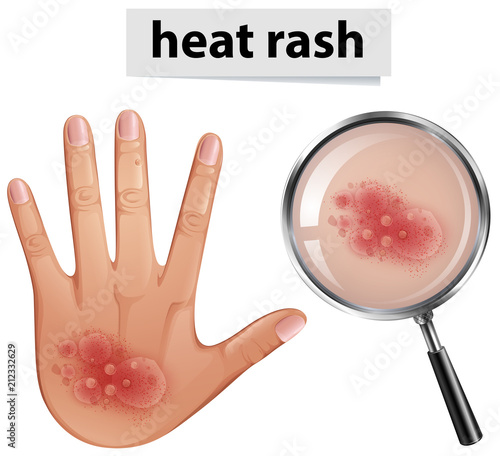 Human Hand with Heat Rash
