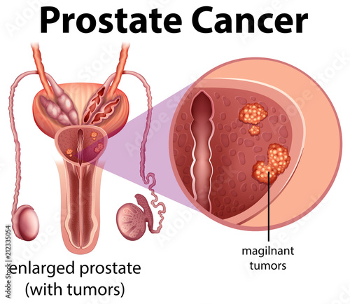 Male Prostate Cancer diagram