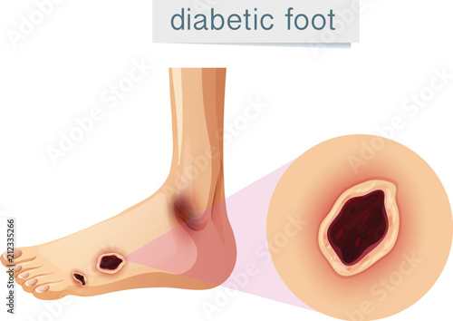 Diabetic foot magnifed on foot