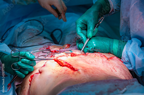 Surgical operation abdominoplasty photo