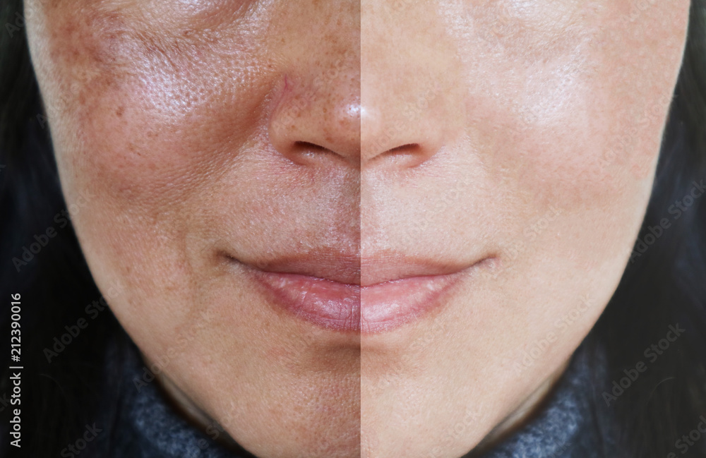Obraz premium Twarz z otwartymi porami i melasma przed i po makijażu lub koncepcji leczenia.