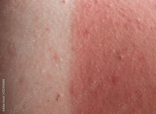 red skin from sunburn
