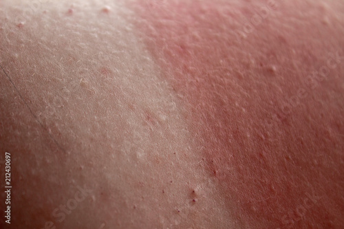 фотографія red skin from sunburn