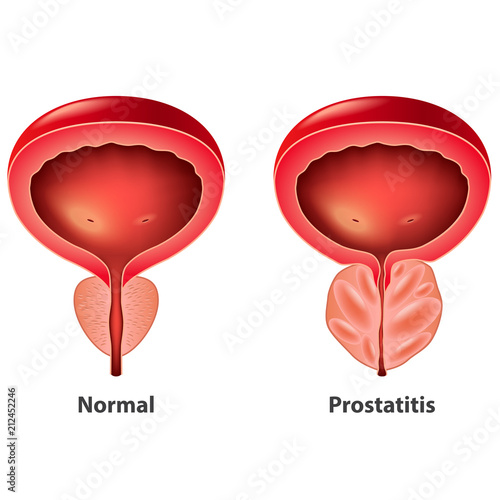 Prostatitis normal and inflamed prostate isolated vector
