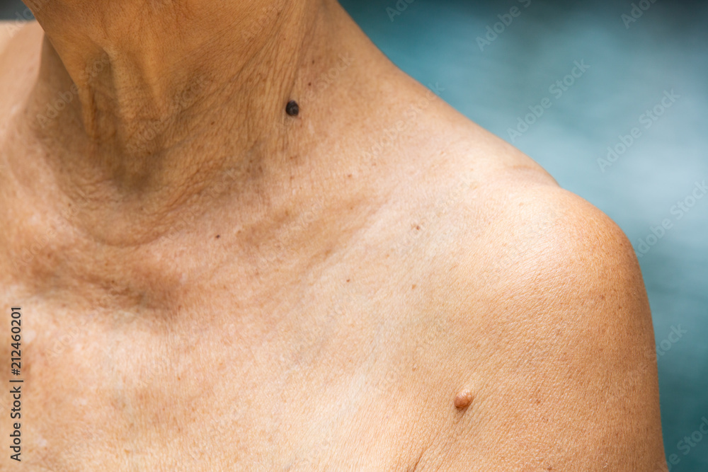 Fototapeta premium Senior woman have Brown mole on brachium, Black mole on neck , Medicine, Close up
