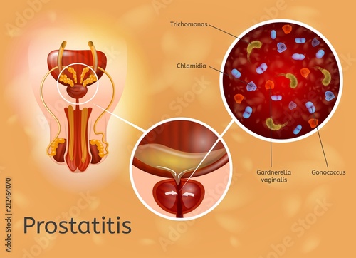 Prostatitis Disease Causes Explanation Vector