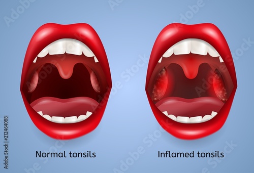 Infected Tonsils Inflammation Vector Concept