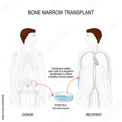 bone marrow transplantation