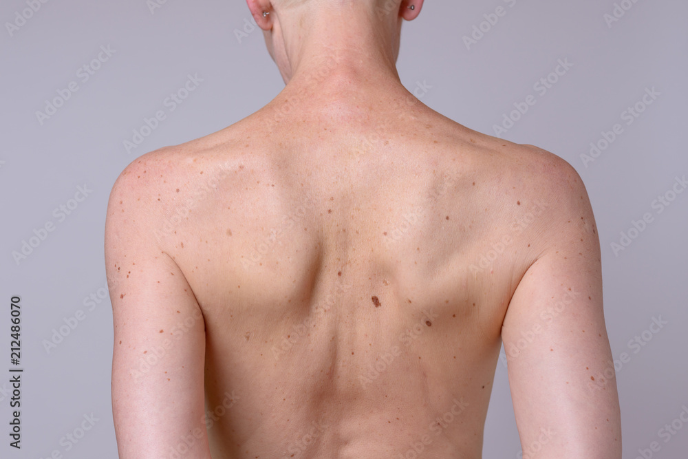 The back of a woman with many liver spots The back of a woman with many liver spots