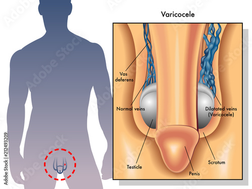 vector medical illustration of the symptoms of varicocele in the man