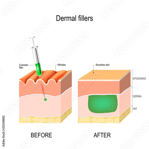 cosmetic or dermal filler. Before and after injection.
