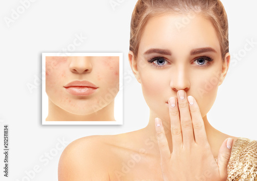 Post-Acne Marks /Treating Acne Scars