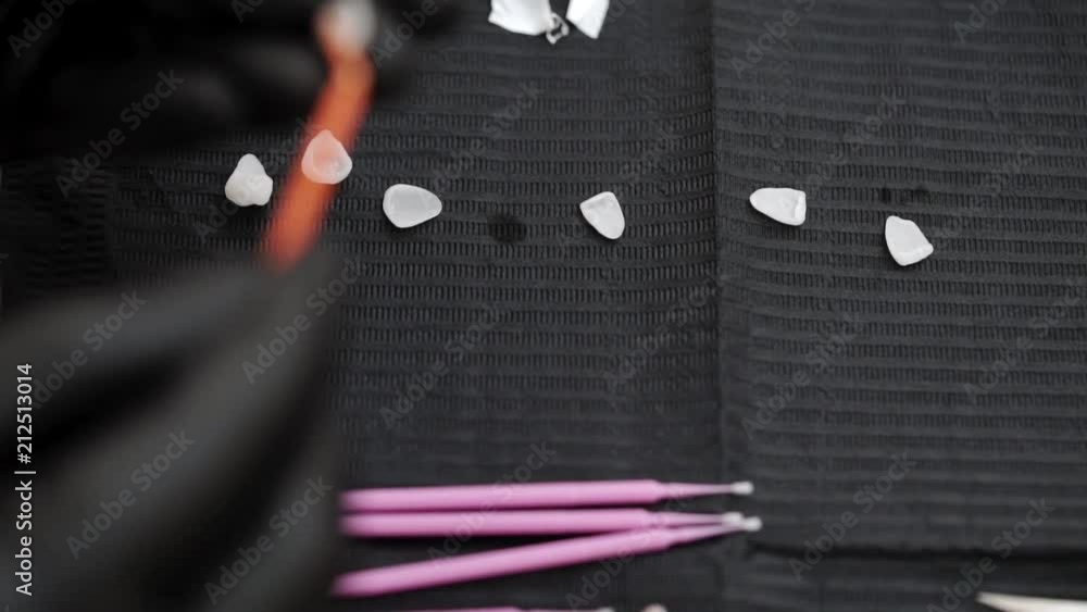 Using glue for veneers in dental clinic Stock ビデオ Adobe Stock