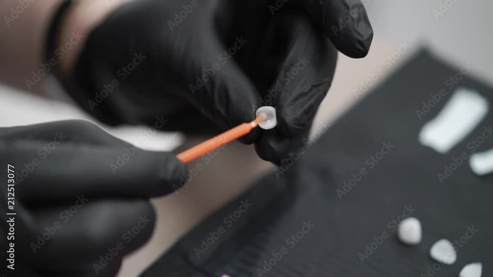 Using glue for veneers in dental clinic Using glue for veneers in dental clinic