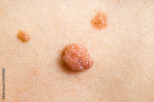 Foto Woman with birthmark on her back, skin tags removal