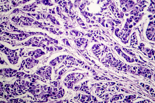 Lymph node cancer, light micrograph, photo under microscope photo