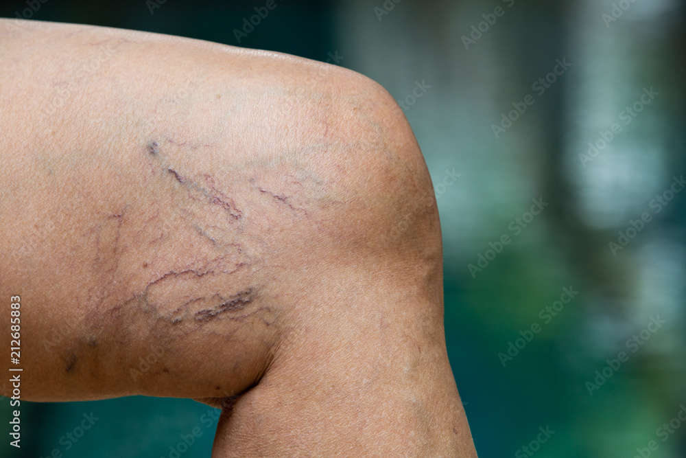 Varicose veins on a leg in Senior woman Varicose veins on a leg in Senior woman
