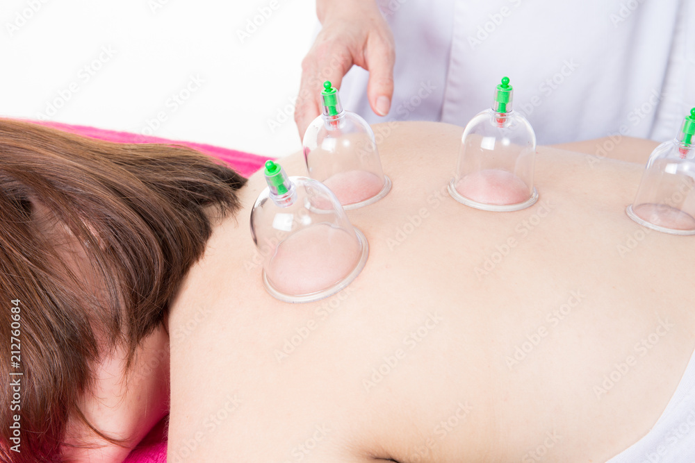 asian suction cup massage for woman back in chinese spa center Stock Photo  | Adobe Stock