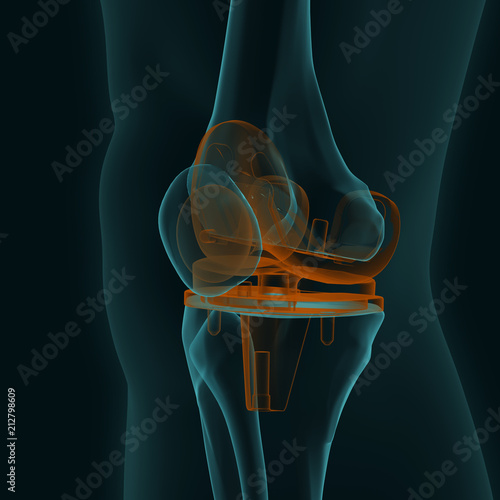 X-ray of a human knee with knee replacement