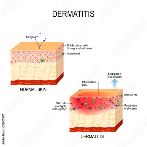 Atopic dermatitis (eczema) photo