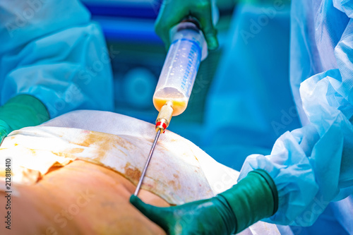 cosmetic liposuction surgery in actual operating room setting showing surgeon hands and cannula photo