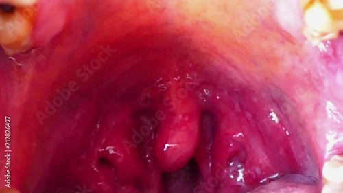tonsil inflammation, a human's tonsils,
 photo