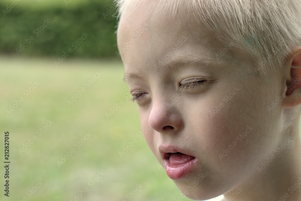 Defect,childcare,medicine and people concept- boy with down syndrome poses for a portrait outdoors. Defect,childcare,medicine and people concept- boy with down syndrome poses for a portrait outdoors.