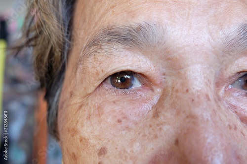 Close up Cataract or pterygium eye Asian Elderly woman