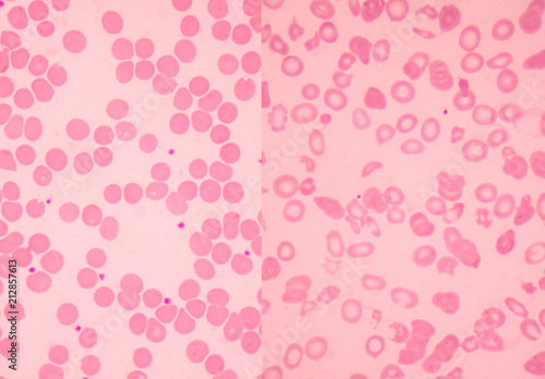 Wallpaper Mural Left normal and right thalassemia blood smear. Torontodigital.ca