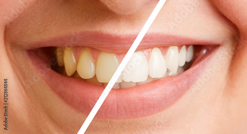 Vergleich von Zähnen vor und nach Zahnreinigung