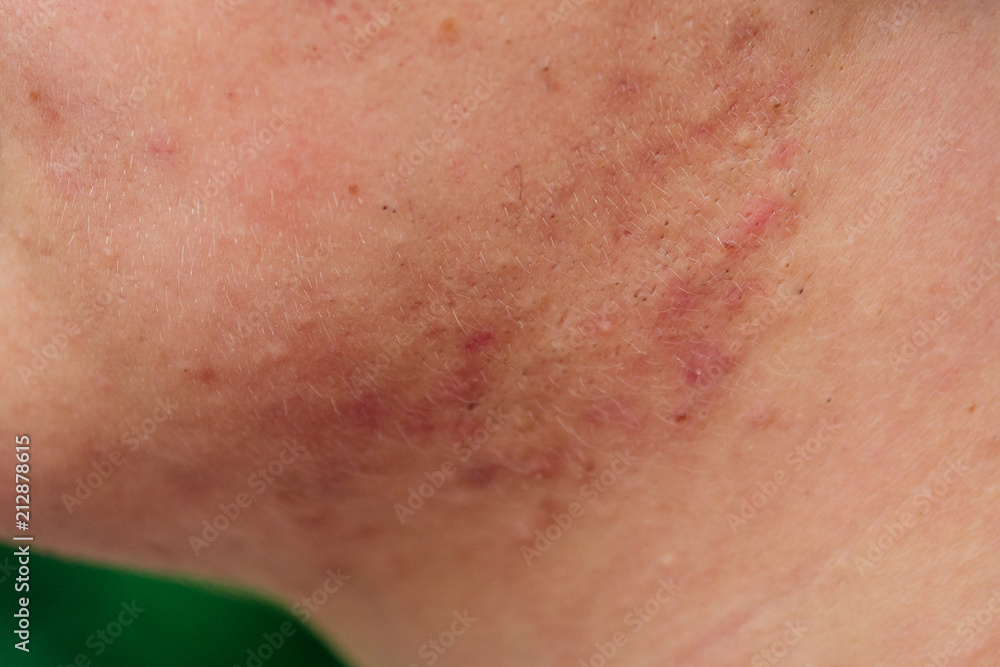 pimples on the face of a man close-ups pimples on the face of a man close-ups