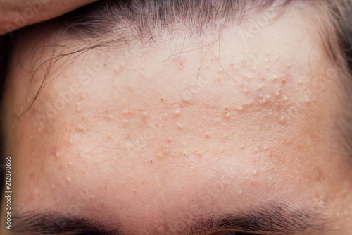 pimples on the face of a man close-ups photo