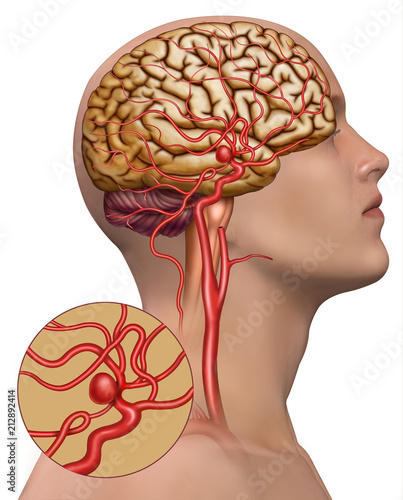 Schematic and descriptive illustration of a human brain aneurysm photo