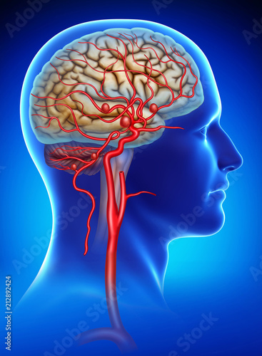 Fotografía Brain aneurysms