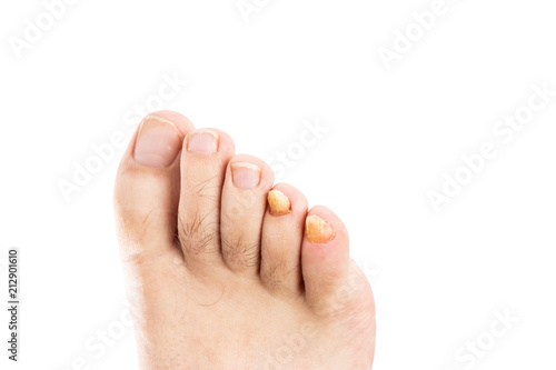 Male toenails with fungal infection. photo