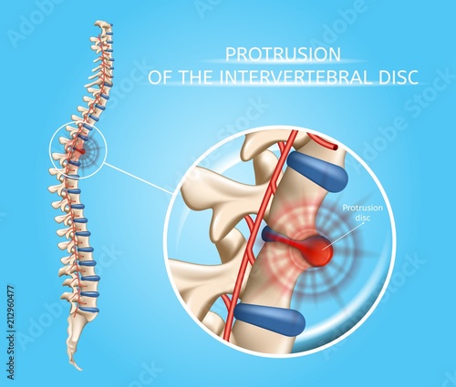 Human Spine Disease Vector Anatomical Infographic