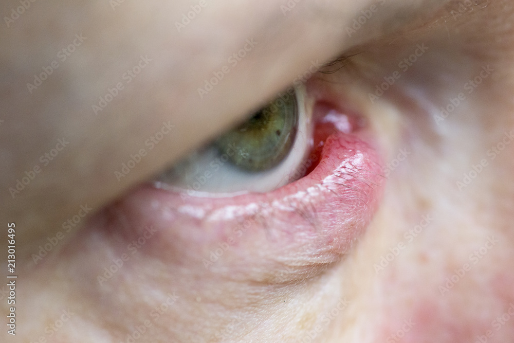 Naklejka premium Chalazion Eye 3 side