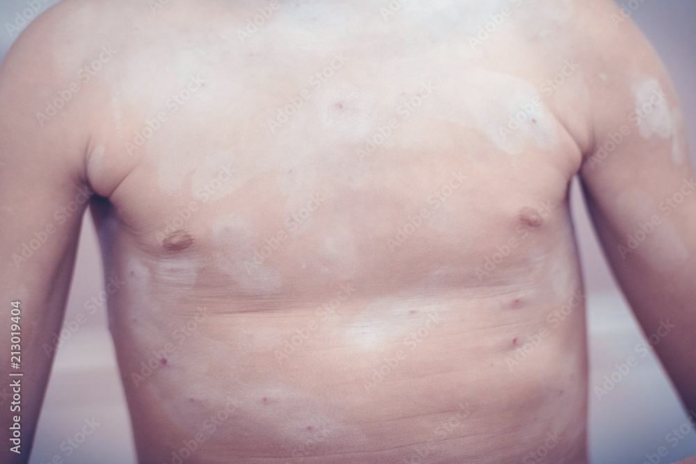 Unrecognizable child with chickenpox. Unrecognizable child with chickenpox.