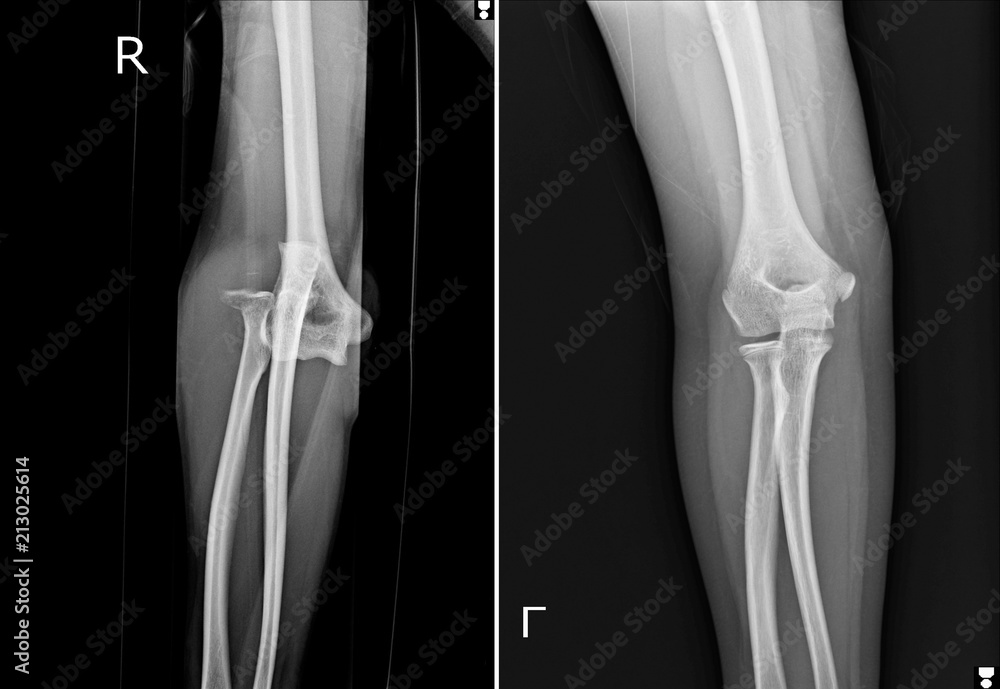 Wall Mural Film elbow AP showed fracture of elbow,Film elbow AP showed dislocation of elbow