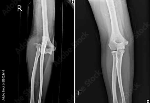 Tableau sur toile Film elbow AP showed fracture of elbow,Film elbow AP showed dislocation of elbow