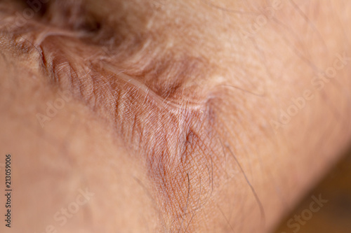 Scar on skin arm. © sinhyu